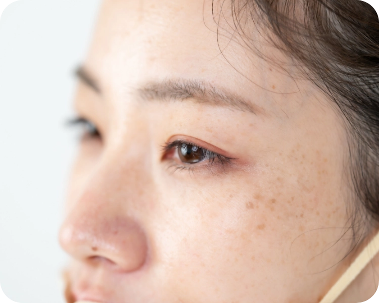 シミ・そばかす