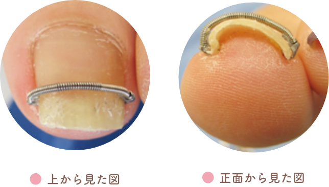 巻き爪マイスターによる巻き爪治療