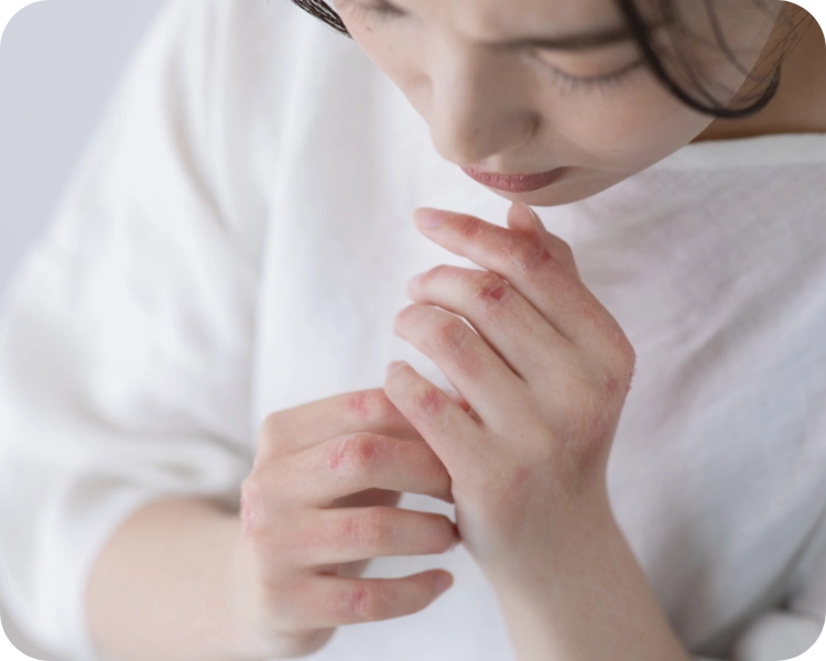 皮むけ・乾燥・かさぶたなどの疾患