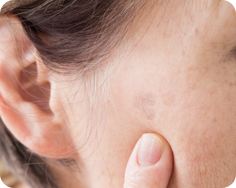 皮膚の色に変化がある疾患