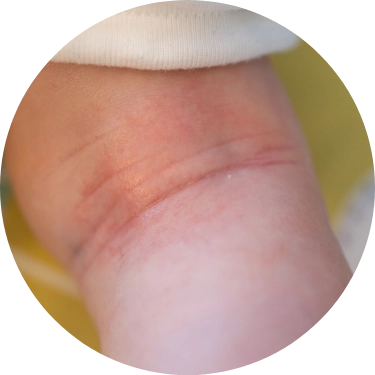 アトピー性皮膚炎