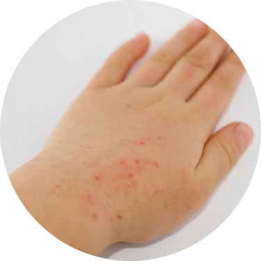 とびひ（伝染性膿痂疹）