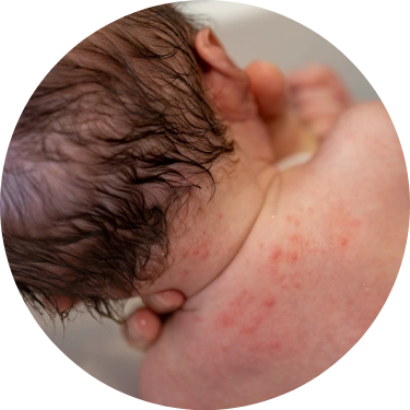 あせも（汗疹）